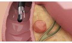 Aqua Medical, Vapor Ablation of Pancreatic Cyst - Video