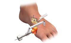 Lapiplasty Mini-Incision - Precision Instrument Set