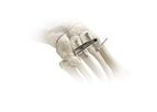 Adductoplasty - Midfoot Correction System
