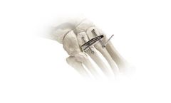 Adductoplasty - Midfoot Correction System