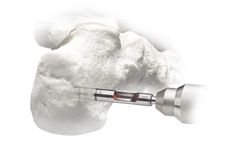FastGrafter - Autograft Harvesting System