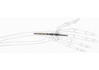 Implate - Wrist Arthrodesis Nail