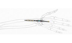 Implate - Wrist Arthrodesis Nail