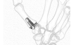 Stablyx - Model CMC - Arthroplasty System