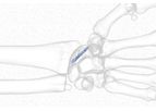 Reduct - Headless Compression Screw System