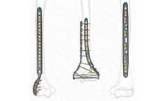 Freefix - Humeral Plating Set