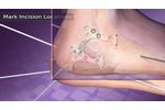 Calcaneal Fracture Animation - Video