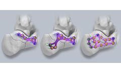 Gorilla - Calc Fracture Plating System