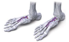 Gorilla - Central Column Fusion Plating System