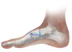 Phantom - Intramedullary Nail