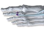 TenoTac - Model 2.0 - Soft Tissue Fixation System