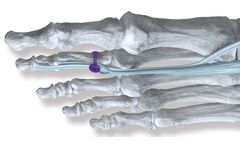 TenoTac - Model 2.0 - Soft Tissue Fixation System