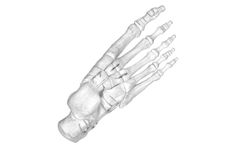 JAWS - Nitinol Staple System