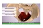 Leva Pelvic Health System Medical AnimationNOT YET RATED - Video