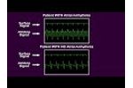 AtriAmp Atrial Electrogram on Bedside Monitor (Atrial Arrhythmia and Sinus Rhythm) - Video