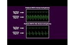 AtriAmp Atrial Electrogram on Bedside Monitor (Atrial Arrhythmia and Sinus Rhythm) - Video