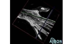 aiSon 3D - Ultrasound Device