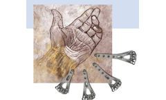 Distal Radius Plate System