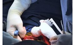 Bone Tumor Resection