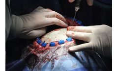 Patient Specific Implant Technology