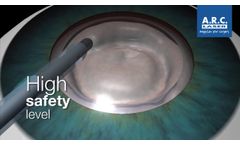 LaserCataractSurgery with CETUS NanoLaser, 3D Animation - Video