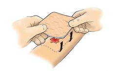 Advazorb - Absorbent Foam Dressing with Film Backing