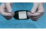 PickUp Bone Marrow Biopsy Needle - Video