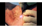 LASEmaR 800 - Transdermal Laser for Spider Veins - Laser Transdermico Teleangectasie [Eufoton] - Video