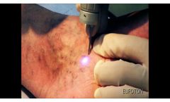 LASEmaR 800 - Transdermal Laser for Spider Veins - Laser Transdermico Teleangectasie [Eufoton] - Video