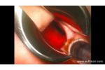 LASEmaR 1000 - ENT Turbinates Laser Treatment - ORL Trattamento Laser Turbinati - Video