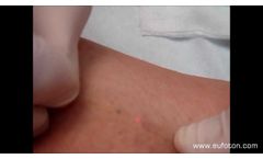 LASEmaR 800 - Endoperivenous Spider Veins - Trattamento Laser Endoperivenoso Teleangectasie - Video