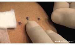 LASEmaR 800 - Endoperivenous Laser Reticular Veins - Laser Endoperivenoso Reticolari - Video