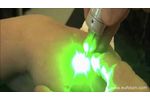 LASEmaR 500 Skin Pigmentations - Pigmentazioni Solari - Video