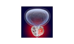Prostate disease
