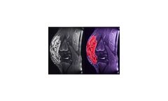 Targeting Fibrosarcoma