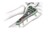 LOQTEQ - Model 2.5 - Distal Radius/Ulna Plates