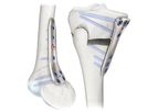 LOQTEQ - Model 4.5 - Osteotomy Plates