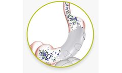 ReShape Vest - Revolutionary, Anatomy-friendly, Laparoscopic, Implantable Device