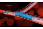 IN Search Avatar image Main Branch Bifurcation Stent (`PROVISIONAL`) by Advanced Bifurcation Systems - Video
