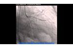 Pre LCx OM1 - Advanced Bifurcation Systems - Video