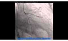 Pre LCx OM1 - Advanced Bifurcation Systems - Video