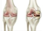 Moximed - Joint Unloading for Patients