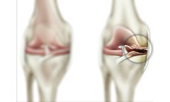 Moximed - Joint Unloading for Patients