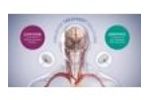 APM017-01.A Cerus Aneurysm Treatment Solutions - Video