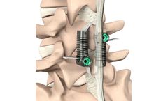 LimiFlex - Dynamic Sagittal Tether