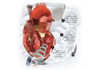 WiSE - Cardiac Resynchronization Therapy (CRT) System