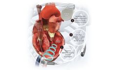 WiSE - Cardiac Resynchronization Therapy (CRT) System