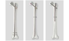 AOS - Model Galileo - Trochanteric Nail System
