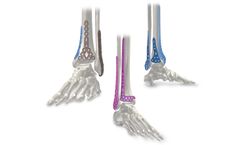 AOS - Fibonacci Lower Extremity Plating System