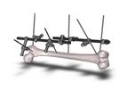 MedSpark - Large Bone External Fixation System
